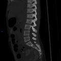Chance fracture with duodenal and pancreatic lacerations (Radiopaedia 43477-50042 Sagittal bone window 14).jpg