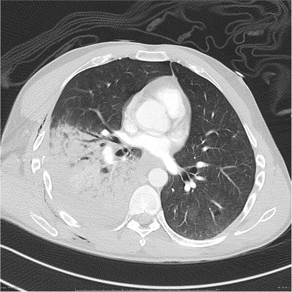 File:Chest and abdomen multi-trauma (Radiopaedia 26294-26425 lung window 58).jpg
