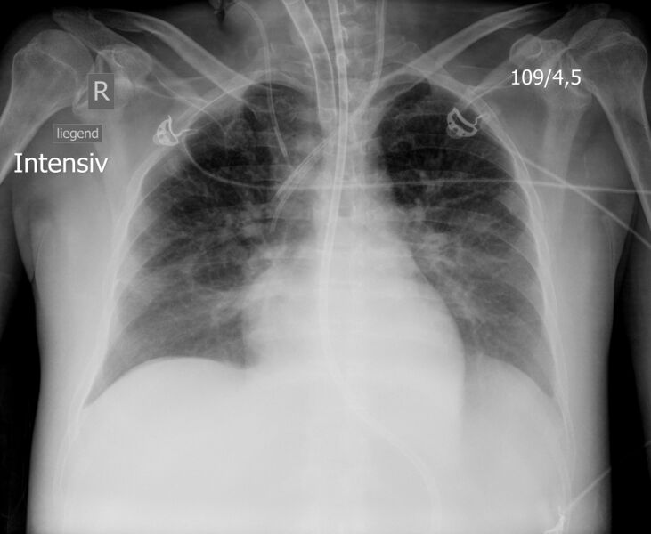 File:Chest radiograph- lines and tubes in intensive care (Radiopaedia 48275).jpeg