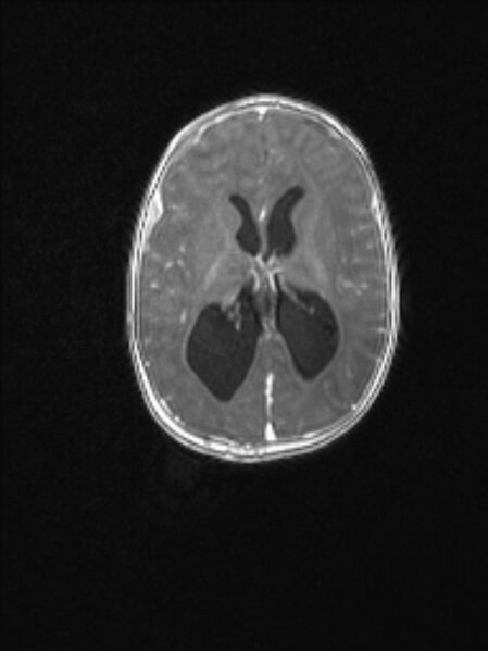 File:Chiari III malformation with occipital encephalocele (Radiopaedia 79446-92559 Axial T1 C+ mpr 54).jpg