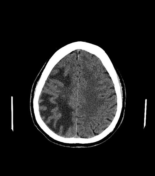 File:Cholangiocarcinoma with cerebral metastases (Radiopaedia 83519-98628 Axial non-contrast 49).jpg