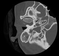 Cholesteatoma (Radiopaedia 20296-20217 bone window 15).jpg