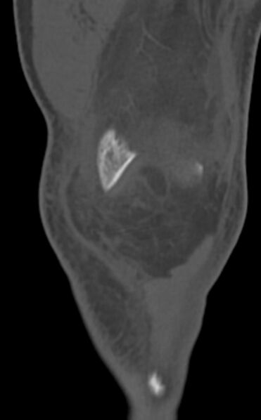 File:Chondrocalcinosis (Radiopaedia 82862-97173 Coronal bone window 20).jpg