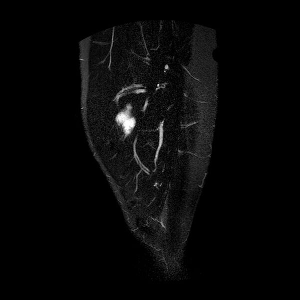 File:Chondrosarcoma arising from exostosis (Radiopaedia 59996-67686 Sagittal STIR 1).jpg