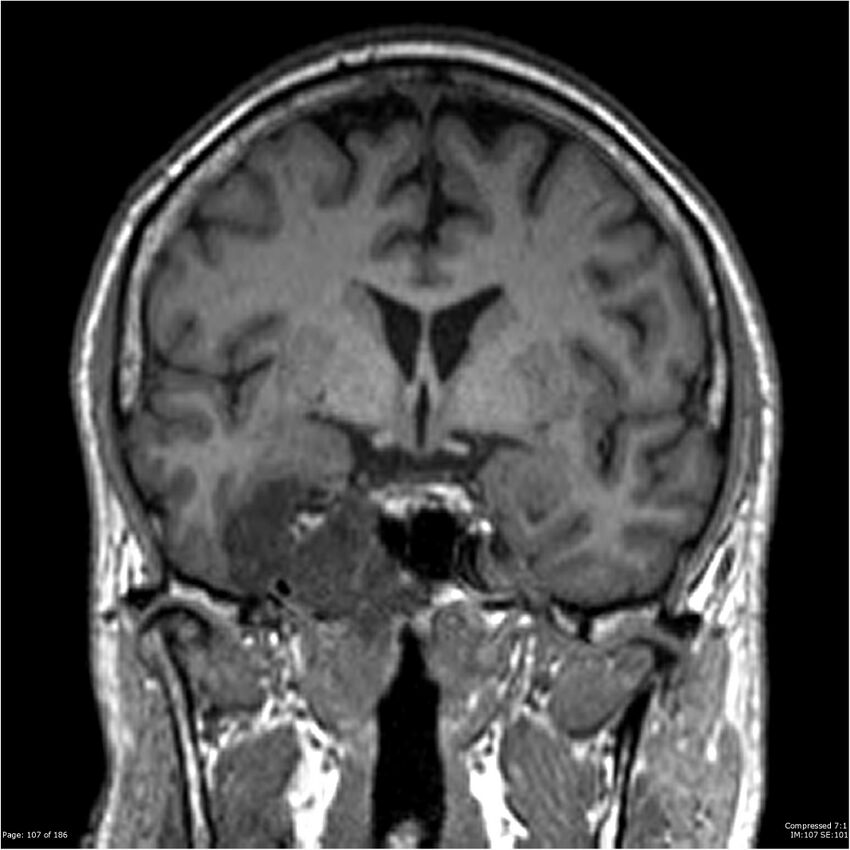 Chondrosarcoma of skull base- grade II (Radiopaedia 40948-43654 Coronal T1 28).jpg