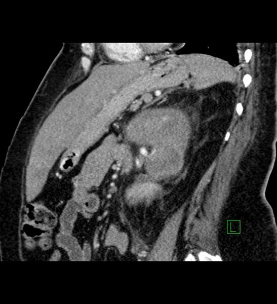 File:Chromophobe renal cell carcinoma (Radiopaedia 84239-99519 D 46).jpg