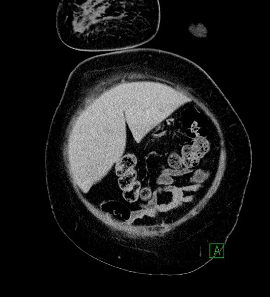 File:Chromophobe renal cell carcinoma (Radiopaedia 84239-99519 F 15).jpg