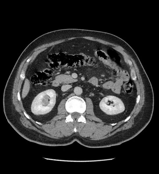 File:Chromophobe renal cell carcinoma (Radiopaedia 86879-103083 C 60).jpg