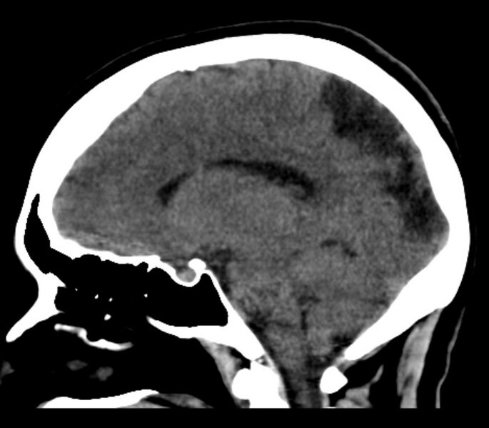 File:Chronic bilateral occipital lobe infarcts (Radiopaedia 31276-31996 C 23).jpg