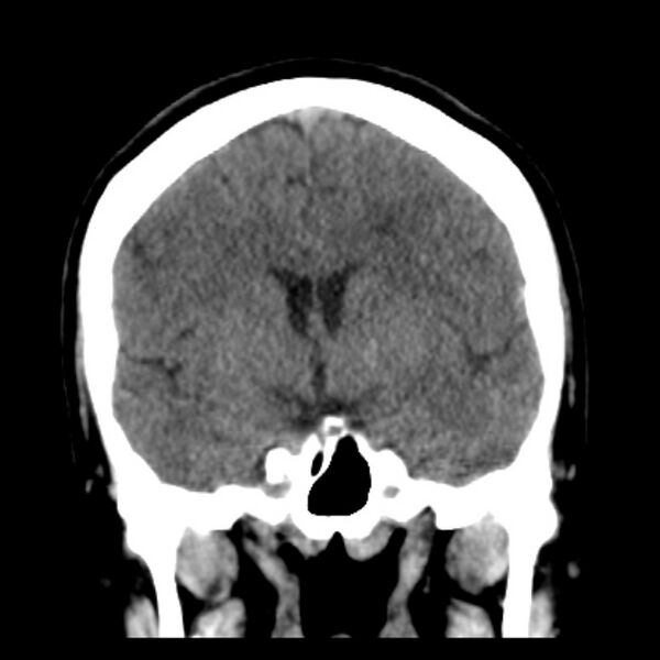 File:Chronic bilateral occipital lobe infarcts (Radiopaedia 31276-31996 Coronal non-contrast 23).jpg