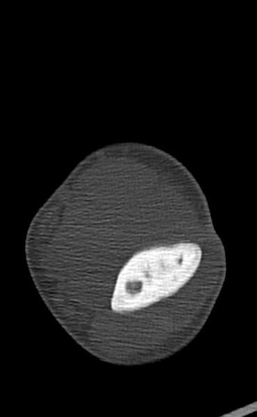 File:Chronic osteomyelitis of the distal humerus (Radiopaedia 78351-90971 Axial bone window 75).jpg