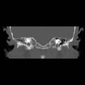 Chronic otomastoiditis (Radiopaedia 27138-27309 Coronal bone window 7).jpg