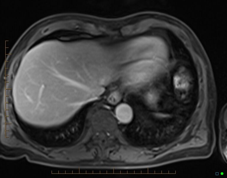 File:Chronic pancreatitis (Radiopaedia 17014-16716 Axial T1 C+ fat sat 2).jpg
