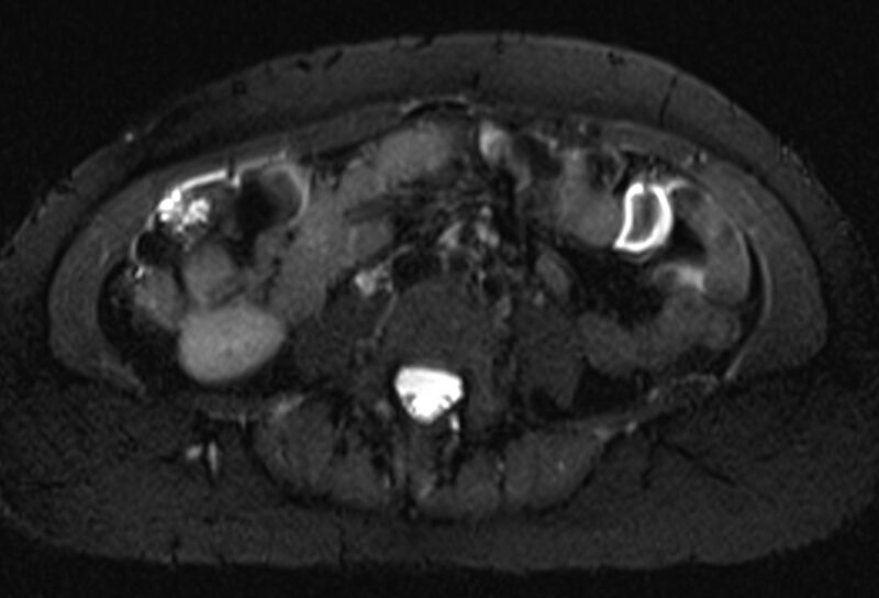 File:Chronic pancreatitis - pancreatic duct calculi (Radiopaedia 71818-82250 Axial T2 fat sat 47).jpg