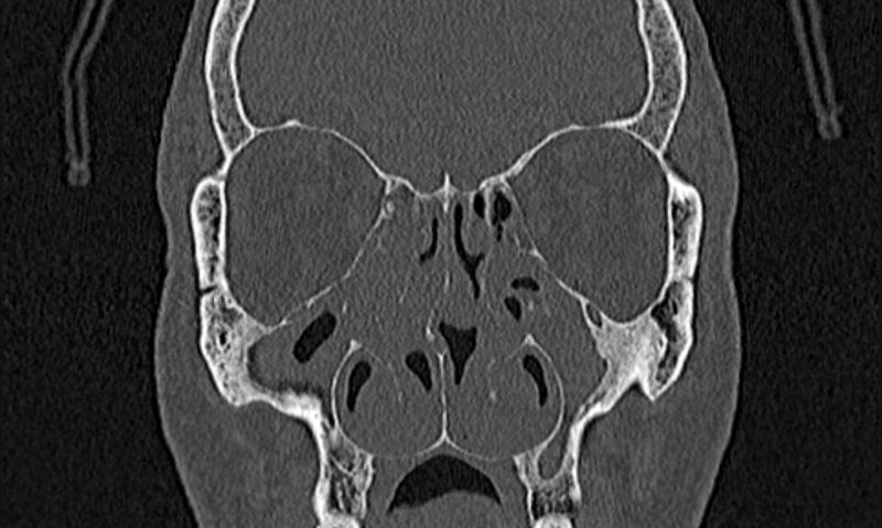 File:Chronic rhinosinusitis (Radiopaedia 65079-74075 Coronal bone window 34).jpg