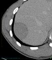 Chronic subcapsular hepatic hematoma (Radiopaedia 29548-30051 H 1).jpg
