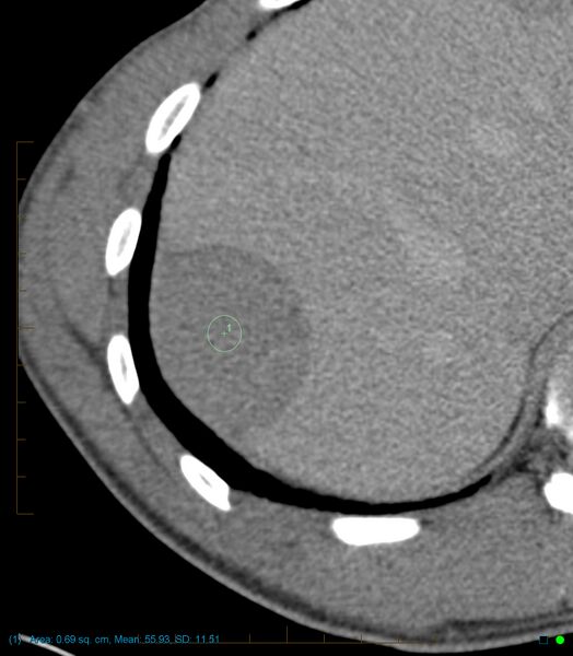 File:Chronic subcapsular hepatic hematoma (Radiopaedia 29548-30051 H 1).jpg