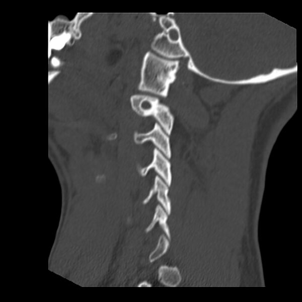 File:Clay-shoveler fracture (Radiopaedia 22568-22590 Sagittal bone window 6).jpg