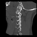 Clay-shoveler fracture (Radiopaedia 22568-22590 Sagittal bone window 7).jpg