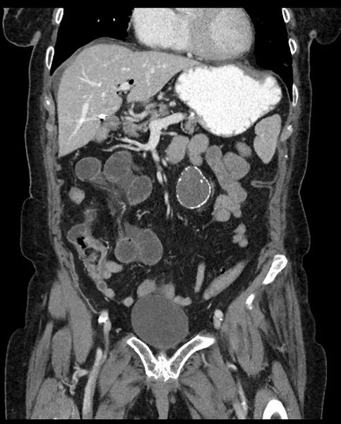 File:Closed loop small bowel obstruction - adhesions (Radiopaedia 59269-66611 B 47).jpg