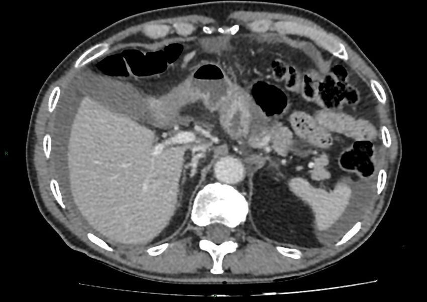 Closed loop small bowel obstruction with ischemia (Radiopaedia 84180-99456 A 26).jpg