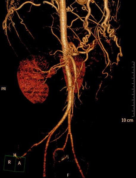 File:Coarctation of the aorta (Radiopaedia 27458-27657 3D 15).jpg