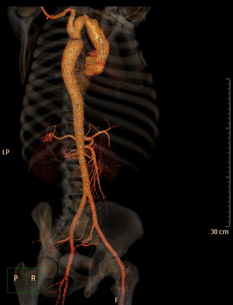 File:Coarctation of the aorta (Radiopaedia 49784-55050 3D VRT 10).jpg