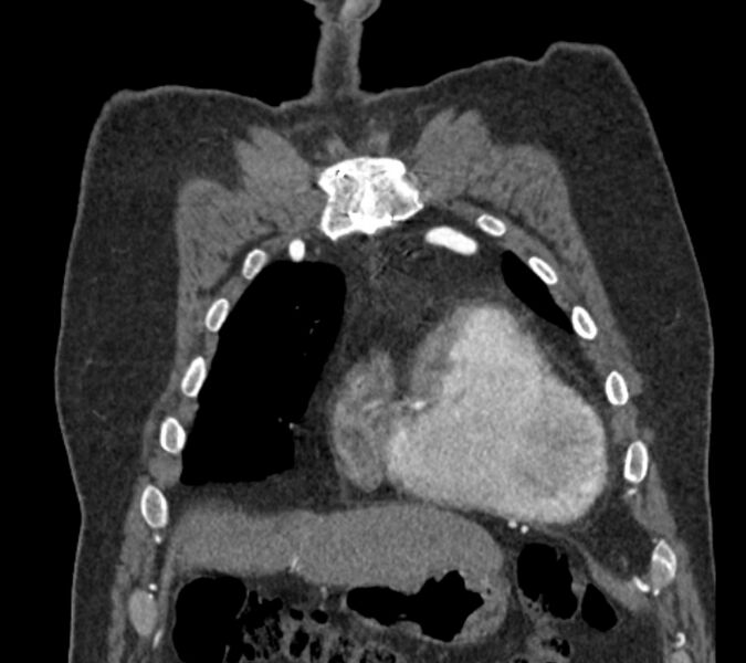 File:Coarctation of the aorta (Radiopaedia 53752-59822 B 17).jpg