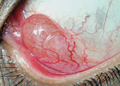 Conjunctival inclusion cyst