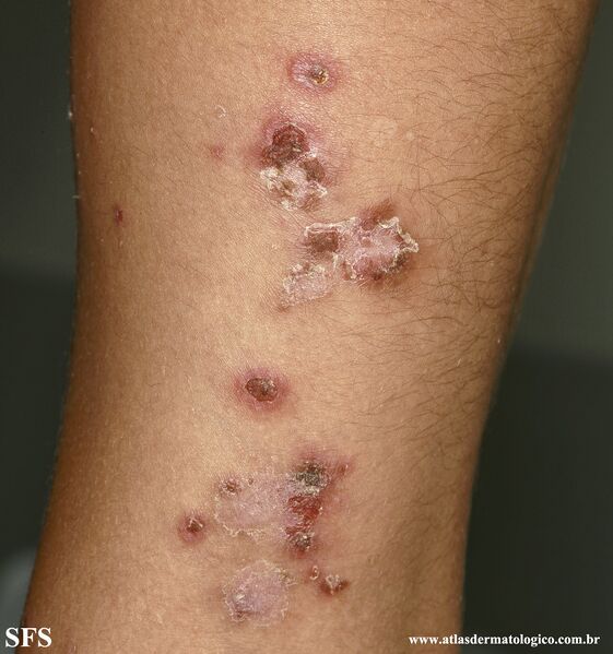 File:Impetigo (Dermatology Atlas 95).jpg