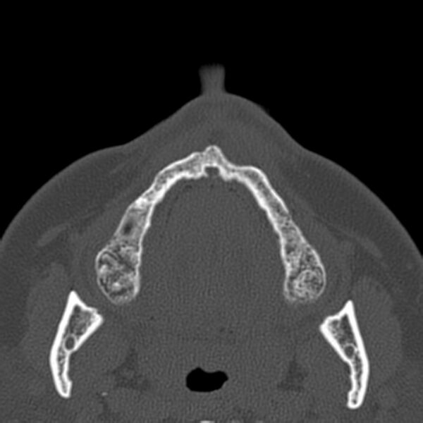 File:Nasolabial cyst (Radiopaedia 33987-35205 Axial bone window 2).jpg
