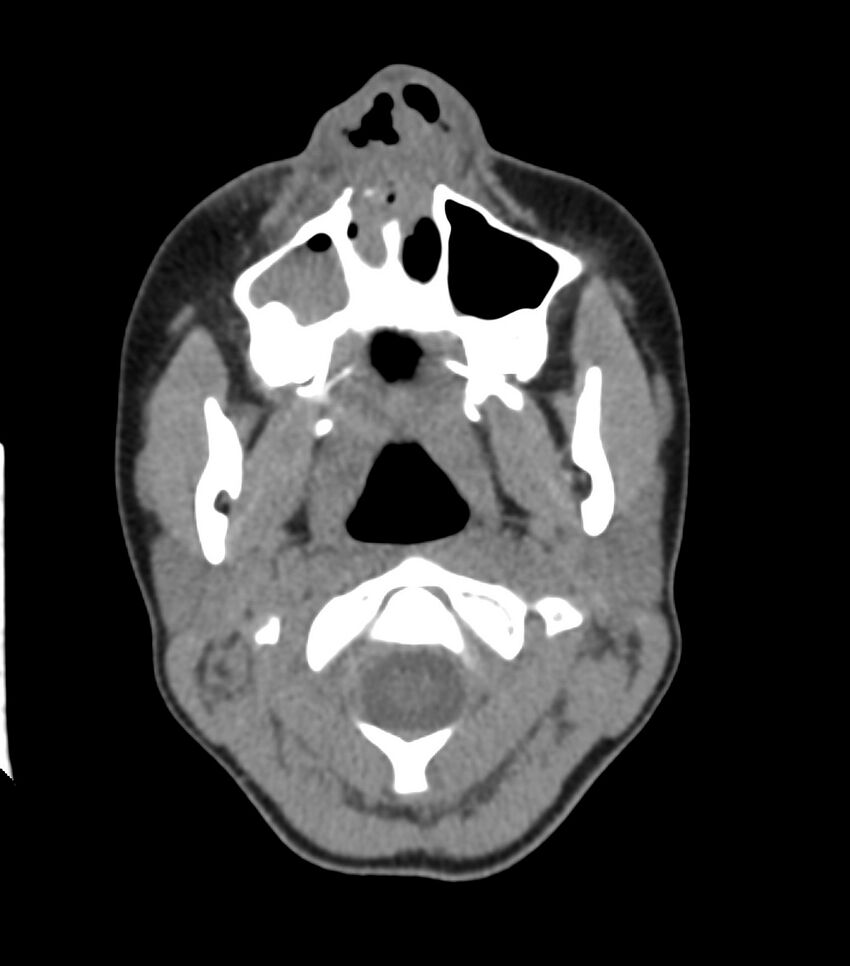 Nasoorbitoethmoid fracture (Radiopaedia 90044-107205 Axial non-contrast 104).jpg