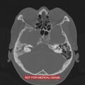 Nasopharyngeal carcinoma recurrence - skull base destruction (Radiopaedia 29107-29490 Axial bone window 81).jpg
