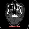 Nasopharyngeal carcinoma recurrence - skull base destruction (Radiopaedia 29107-29491 A 13).jpg