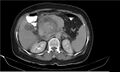 Necrotizing pancreatitis (Radiopaedia 20595-20495 Axial C+ delayed 14).jpg