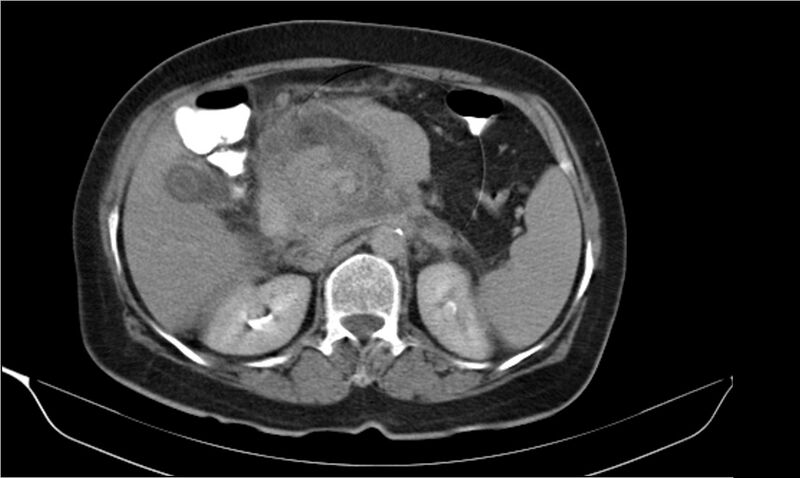 File:Necrotizing pancreatitis (Radiopaedia 20595-20495 Axial C+ delayed 14).jpg