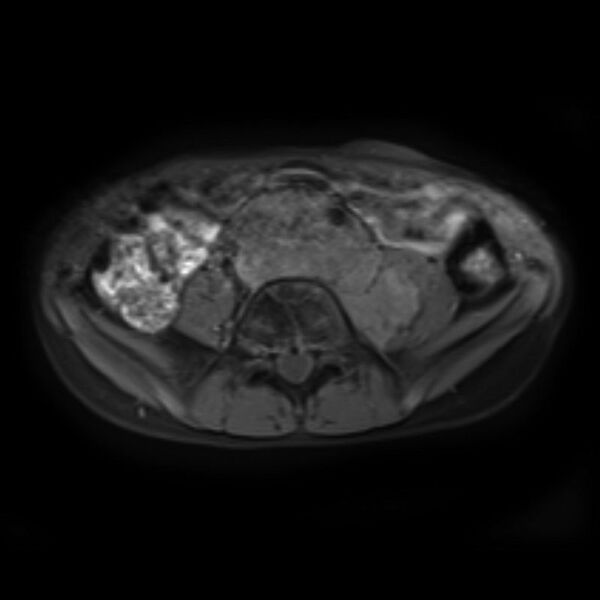 File:Neuroblastoma (Radiopaedia 6010-7518 Axial T1 fat sat 1).jpg