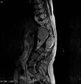Neurofibromatosis type 2 - cranial and spinal involvement (Radiopaedia 5351-7112 B 13).jpg