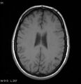 Neurosarcoidosis (Radiopaedia 10930-17204 Axial T1 13).jpg