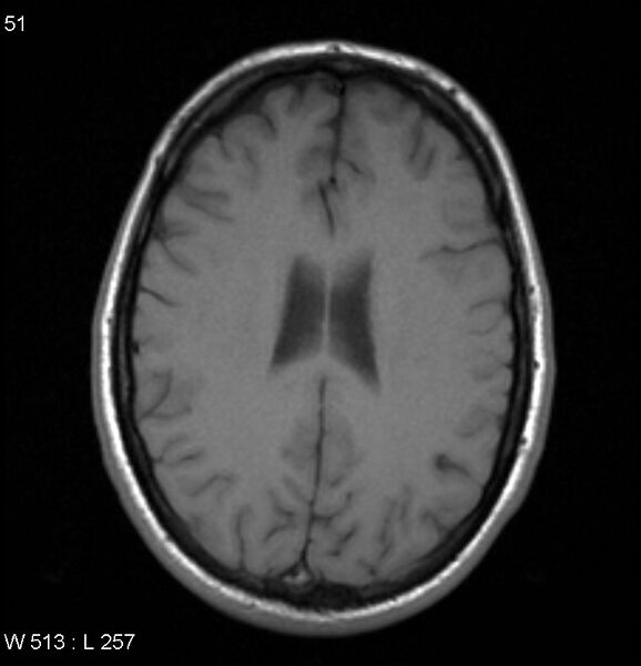 File:Neurosarcoidosis (Radiopaedia 10930-17204 Axial T1 13).jpg