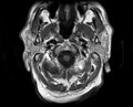 Non-Hodgkin lymphoma - parotid gland (Radiopaedia 71531-81890 Axial T1 17).jpg