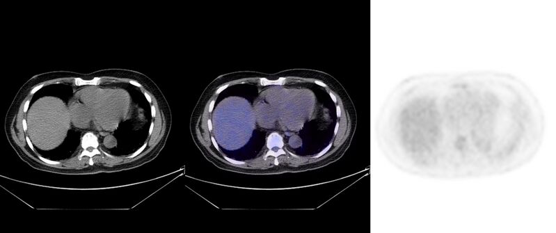 File:Non-Hodgkin lymphoma involving seminal vesicles with development of interstitial pneumonitis during Rituximab therapy (Radiopaedia 32703-33752 ax CT Fus PET 27).jpg