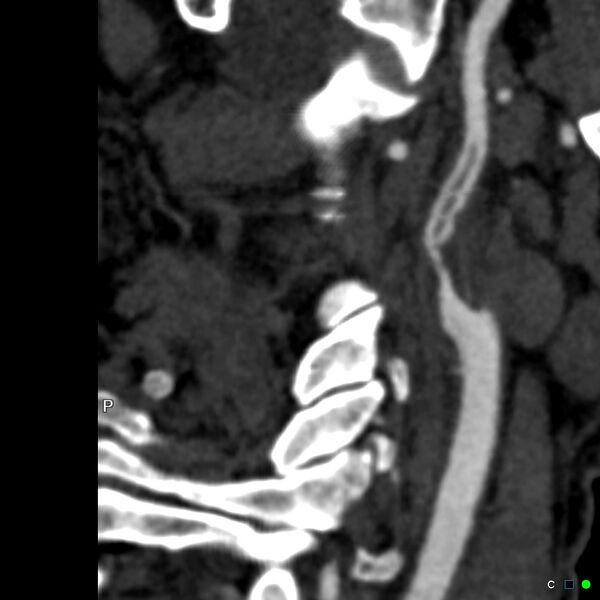 File:Non-occlusive intraluminal internal carotid artery thrombus (Radiopaedia 37751-39658 A 25).jpg