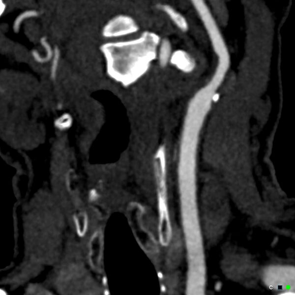 File:Non-occlusive intraluminal internal carotid artery thrombus (Radiopaedia 37751-39658 C 69).jpg