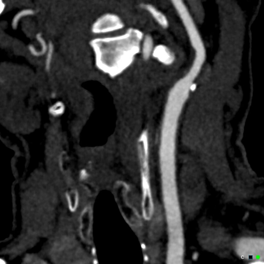 Non-occlusive intraluminal internal carotid artery thrombus (Radiopaedia 37751-39658 C 69).jpg