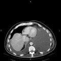 Non Hodgkin lymphoma in a patient with ankylosing spondylitis (Radiopaedia 84323-99621 B 26).jpg