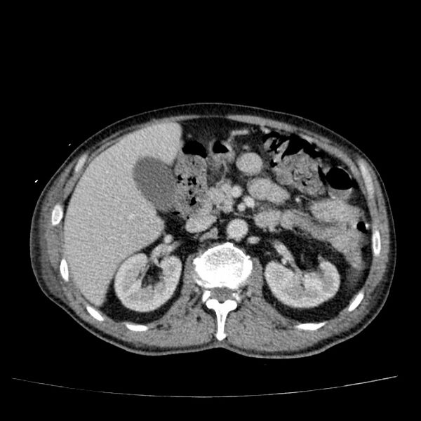 File:Non small-cell lung cancer (Radiopaedia 24467-24769 C+ delayed 69).jpg