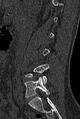 Normal CT lumbar spine (Radiopaedia 53981-60118 Sagittal bone window 28).jpg