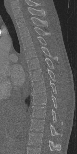 File:Normal CT thoracic spine (Radiopaedia 40181-42688 Sagittal bone window 36).png
