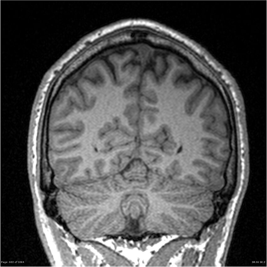 Normal brain MRI (non-focal epilepsy protocol) (Radiopaedia 38571-40700 Coronal T1 27).jpg